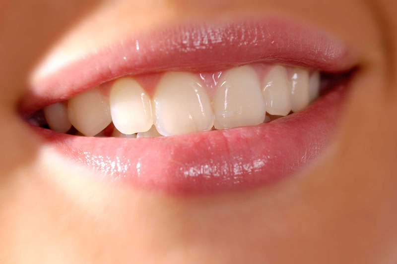 veneers_crowns_central_dentists_tingalpa
